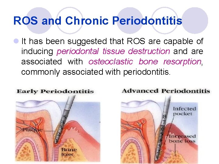 ROS and Chronic Periodontitis l It has been suggested that ROS are capable of
