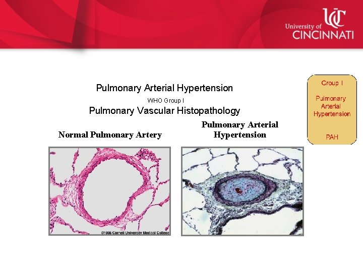 Pulmonary Arterial Hypertension WHO Group I Pulmonary Vascular Histopathology Normal Pulmonary Artery Pulmonary Arterial