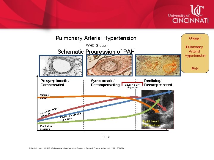 Pulmonary Arterial Hypertension WHO Group I Schematic Progression of PAH Presymptomatic/ Compensated Symptomatic/ Decompensating