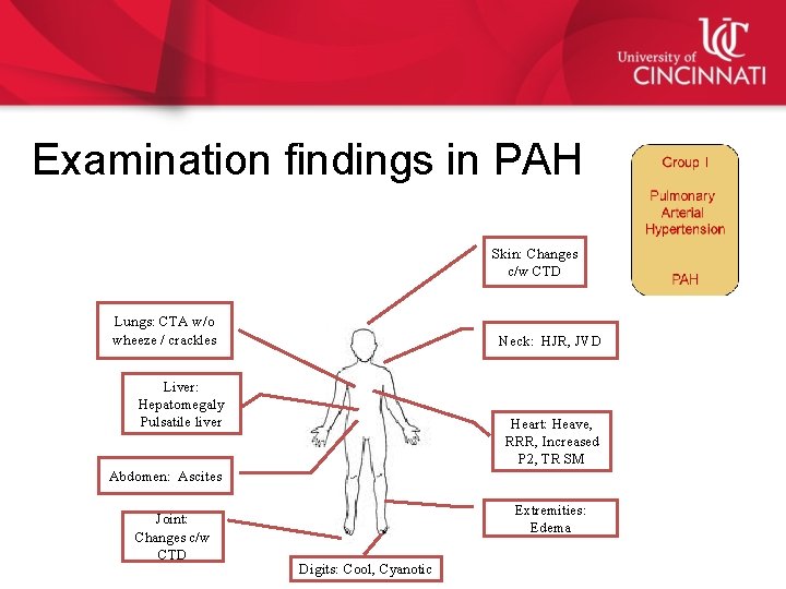 Examination findings in PAH Skin: Changes c/w CTD Lungs: CTA w/o wheeze / crackles