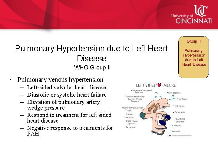 Pulmonary Hypertension due to Left Heart Disease WHO Group II • Pulmonary venous hypertension