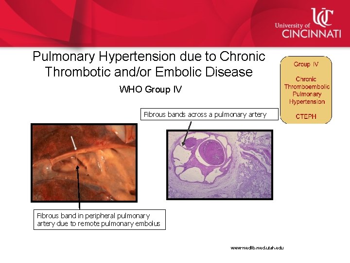 Pulmonary Hypertension due to Chronic Thrombotic and/or Embolic Disease WHO Group IV Fibrous bands