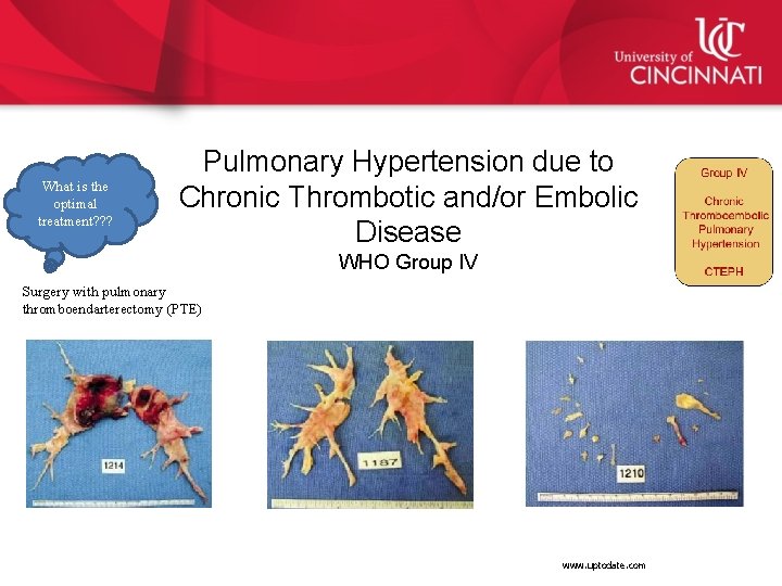 What is the optimal treatment? ? ? Pulmonary Hypertension due to Chronic Thrombotic and/or