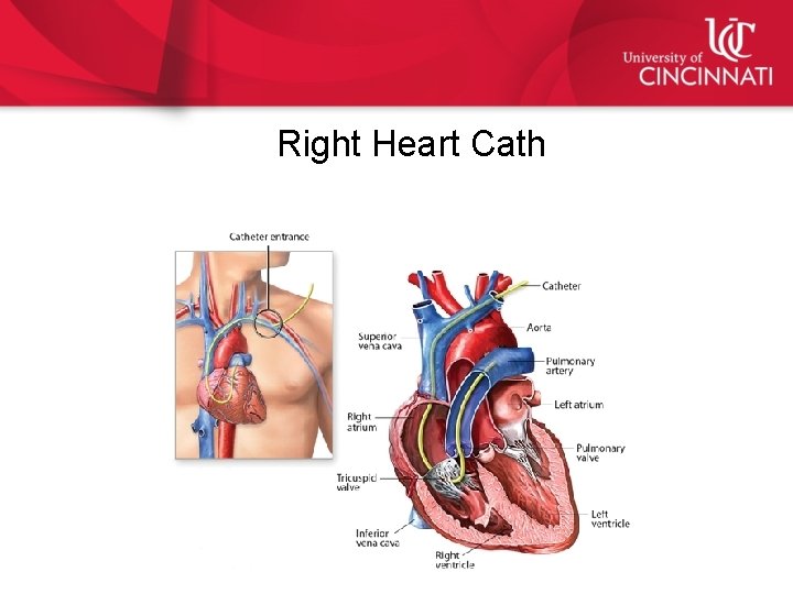 Right Heart Cath 