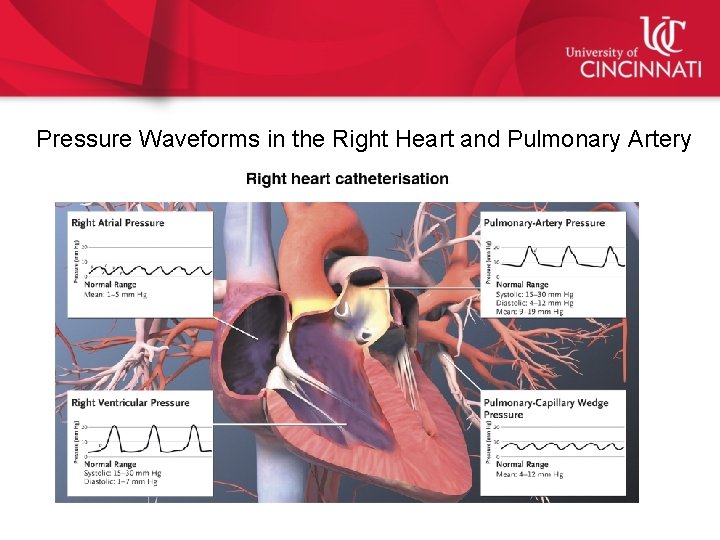 Pressure Waveforms in the Right Heart and Pulmonary Artery 