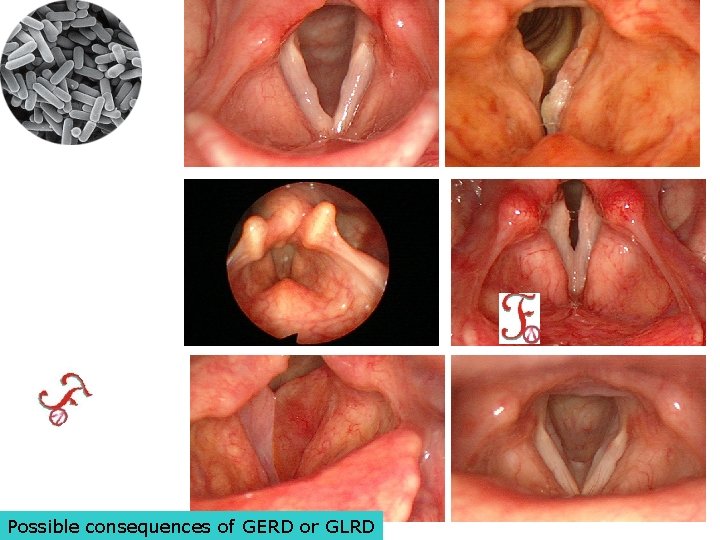 Possible consequences of GERD or GLRD 