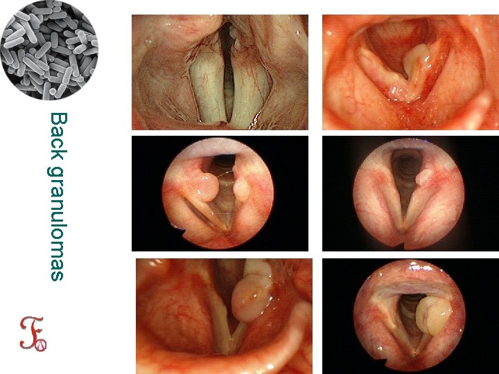 Back granulomas 