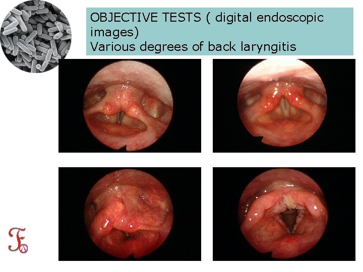 OBJECTIVE TESTS ( digital endoscopic images) Various degrees of back laryngitis 