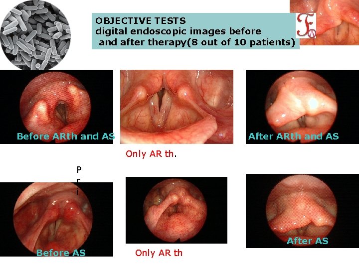 OBJECTIVE TESTS digital endoscopic images before and after therapy(8 out of 10 patients) Before