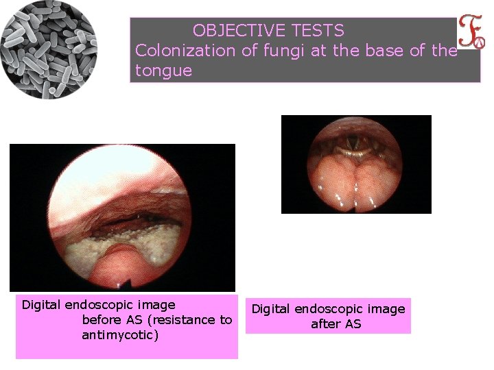 OBJECTIVE TESTS Colonization of fungi at the base of the tongue Digital endoscopic image