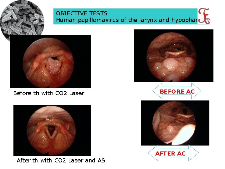 OBJECTIVE TESTS Human papillomavirus of the larynx and hypopharinx Before th with CO 2