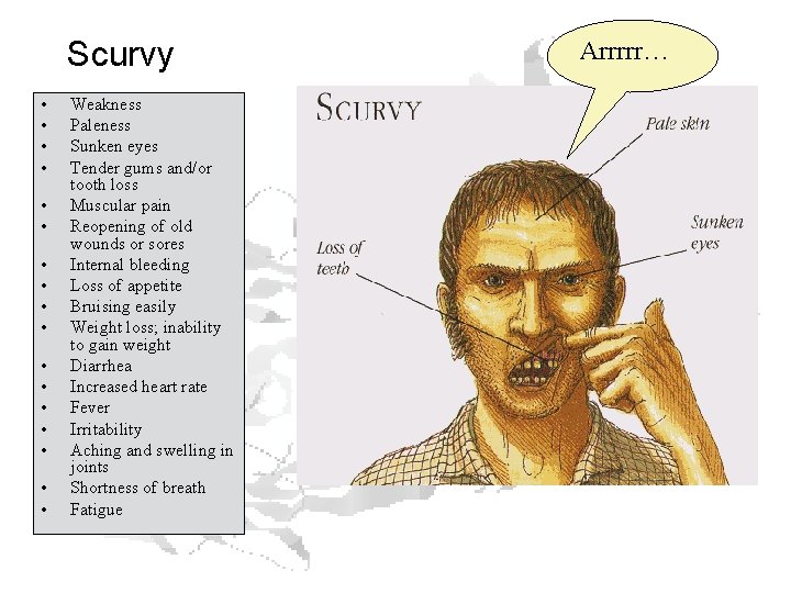 Scurvy • • • • • Weakness Paleness Sunken eyes Tender gums and/or tooth