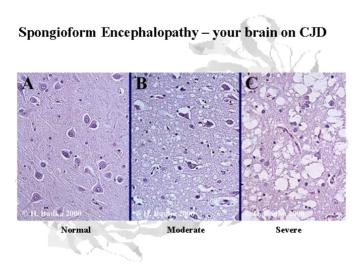 Spongioform Encephalopathy – your brain on CJD Normal Moderate Severe 