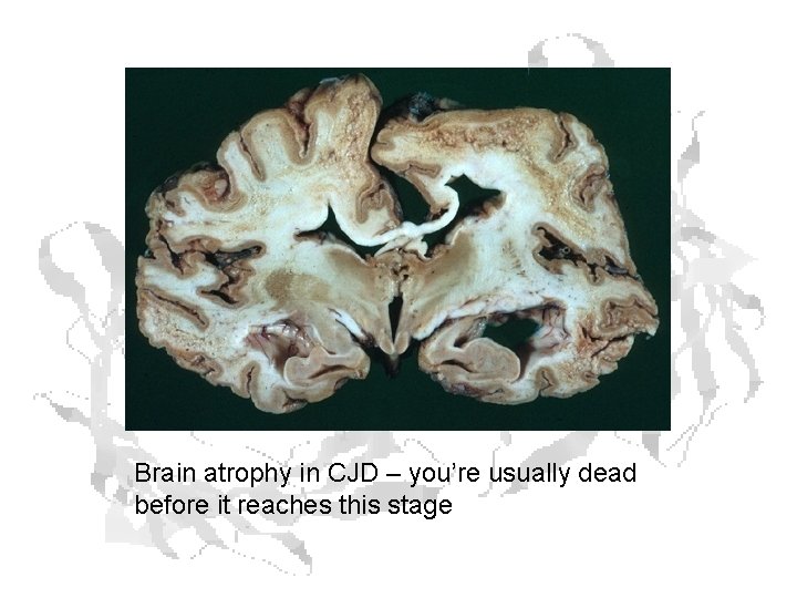 Brain atrophy in CJD – you’re usually dead before it reaches this stage 
