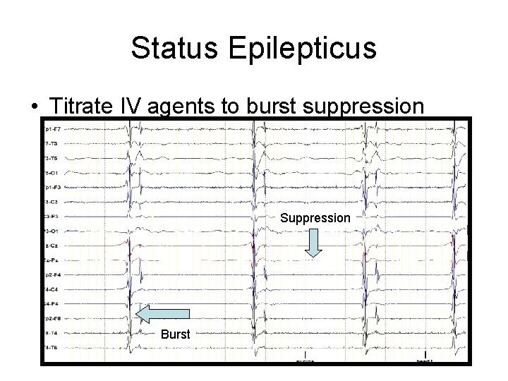 Status Epilepticus • Titrate IV agents to burst suppression Suppression Burst Status Epilepticus • Titrate IV agents to burst suppression Suppression Burst
