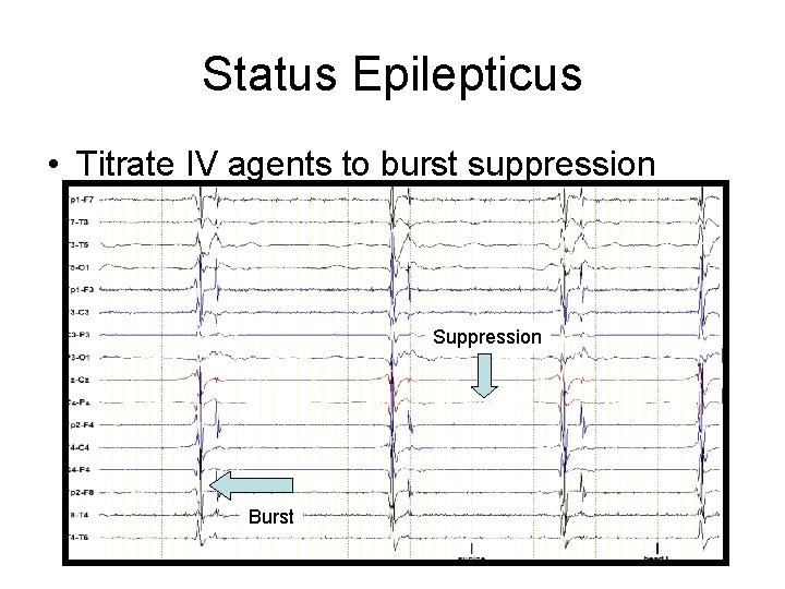 Status Epilepticus • Titrate IV agents to burst suppression Suppression Burst 