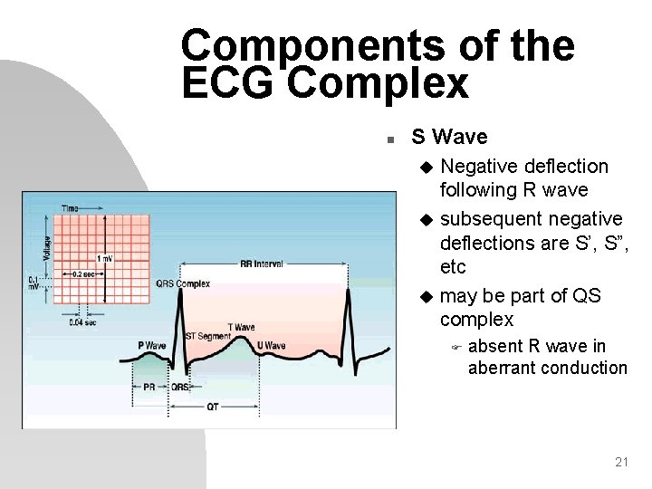 Components of the ECG Complex n S Wave Negative deflection following R wave u