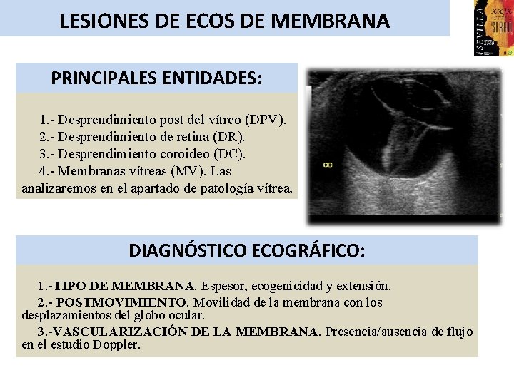 LESIONES DE ECOS DE MEMBRANA PRINCIPALES ENTIDADES: 1. - Desprendimiento post del vítreo (DPV).