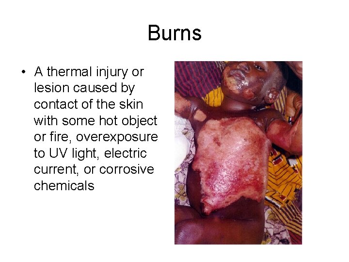 Burns • A thermal injury or lesion caused by contact of the skin with