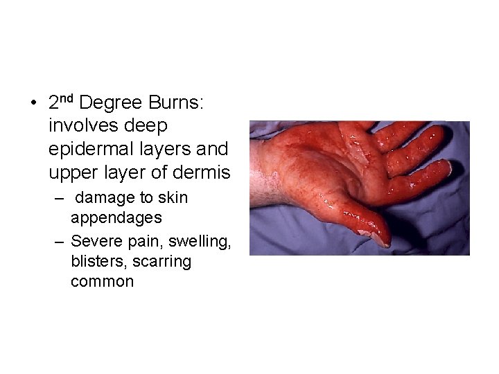  • 2 nd Degree Burns: involves deep epidermal layers and upper layer of