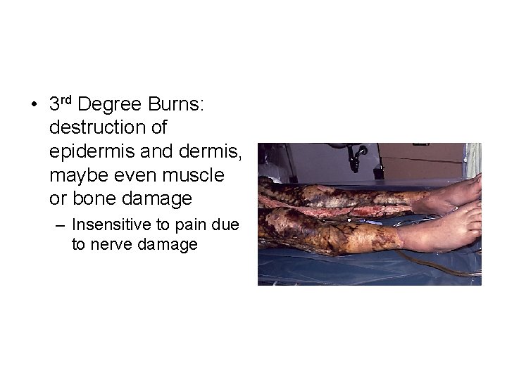  • 3 rd Degree Burns: destruction of epidermis and dermis, maybe even muscle