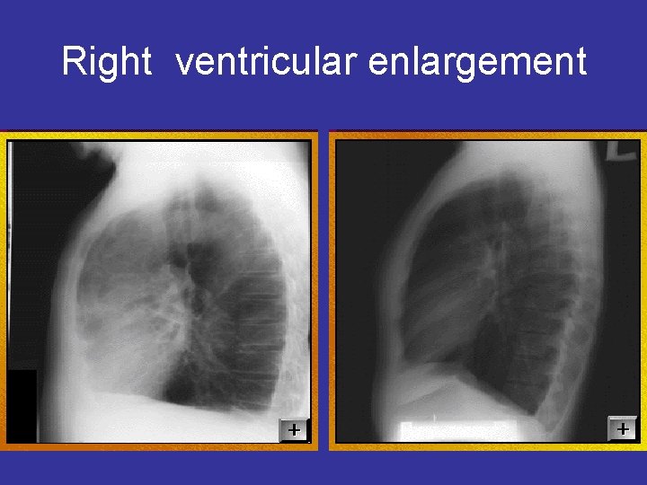 Right ventricular enlargement 