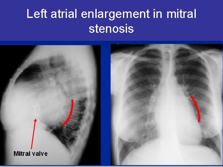 Left atrial enlargement in mitral stenosis 