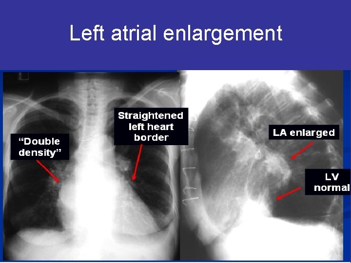 Left atrial enlargement 