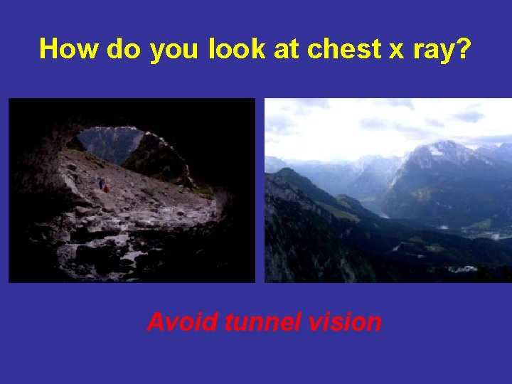 How do you look at chest x ray? Avoid tunnel vision 