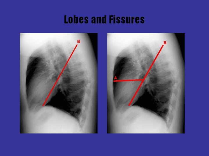 Lobes and Fissures 