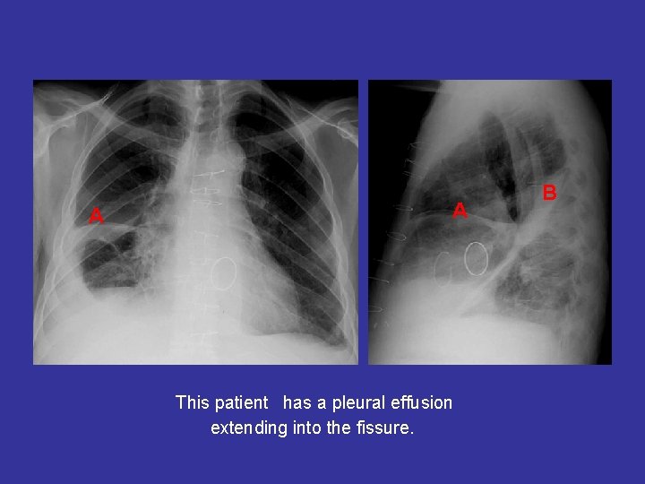 A A This patient has a pleural effusion extending into the fissure. B 