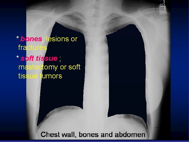 * bones; lesions or fractures * soft tissue ; mastectomy or soft tissue tumors