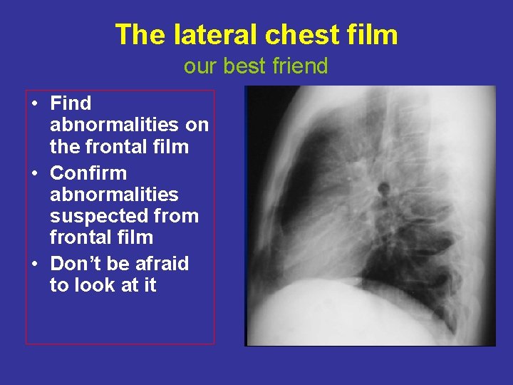 The lateral chest film our best friend • Find abnormalities on the frontal film