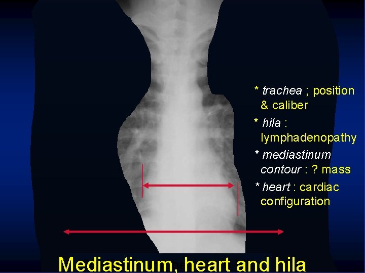  * trachea ; position & caliber * hila : lymphadenopathy * mediastinum contour