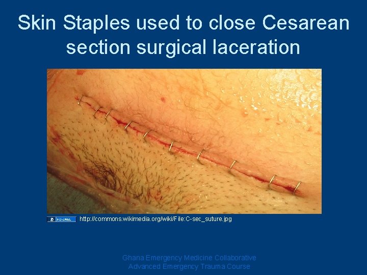 Skin Staples used to close Cesarean section surgical laceration http: //commons. wikimedia. org/wiki/File: C-sec_suture.