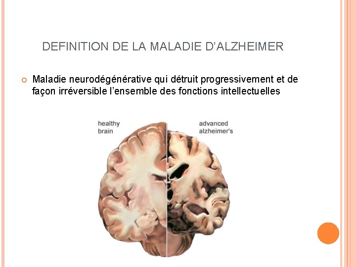 DEFINITION DE LA MALADIE D’ALZHEIMER Maladie neurodégénérative qui détruit progressivement et de façon irréversible