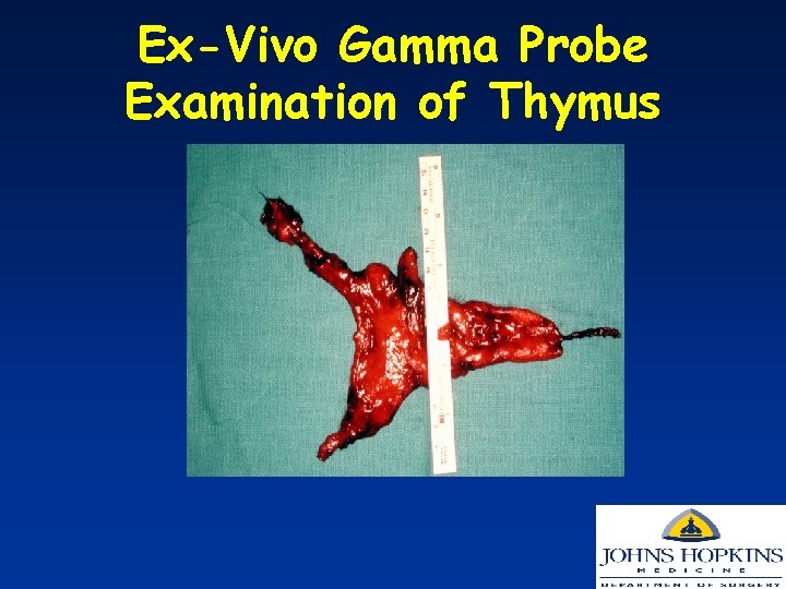 Ex-Vivo Gamma Probe Examination of Thymus 