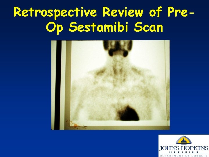 Retrospective Review of Pre. Op Sestamibi Scan 