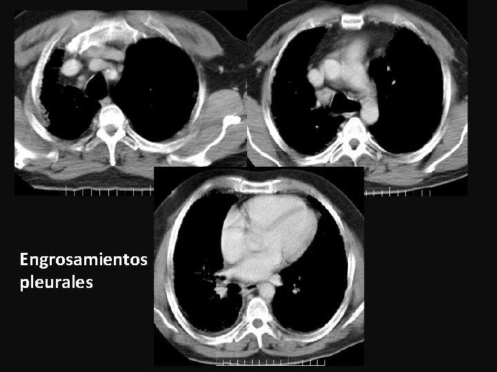 Engrosamientos pleurales 