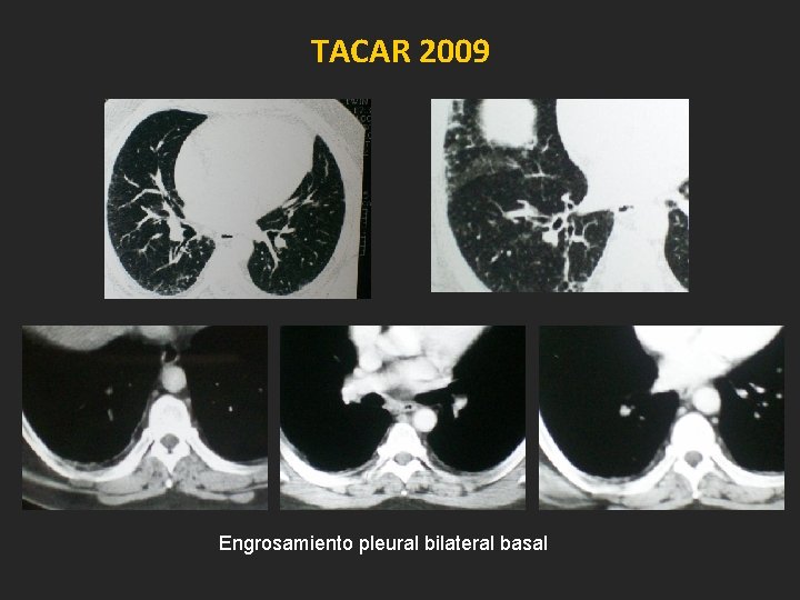 TACAR 2009 Engrosamiento pleural bilateral basal 