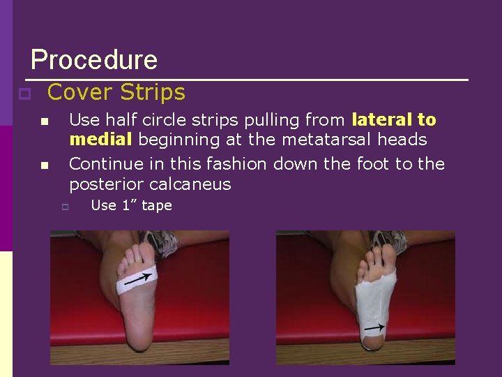 Procedure p Cover Strips n n Use half circle strips pulling from lateral to