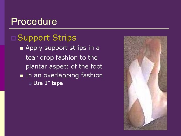 Procedure p Support Strips n Apply support strips in a n tear drop fashion