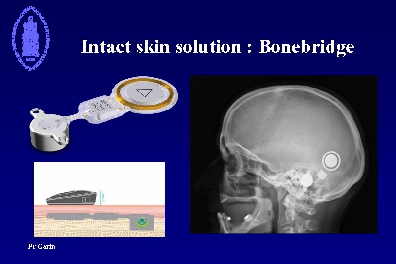 Intact skin solution : Bonebridge Pr Garin 