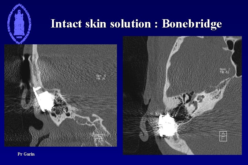 Intact skin solution : Bonebridge Pr Garin 