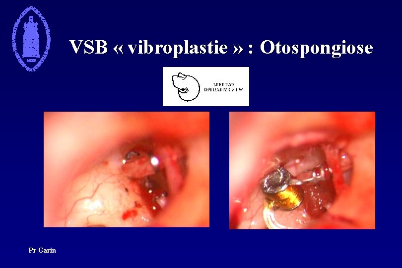VSB « vibroplastie » : Otospongiose Pr Garin 