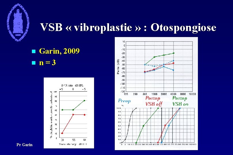 VSB « vibroplastie » : Otospongiose n n Pr Garin, 2009 n = 3