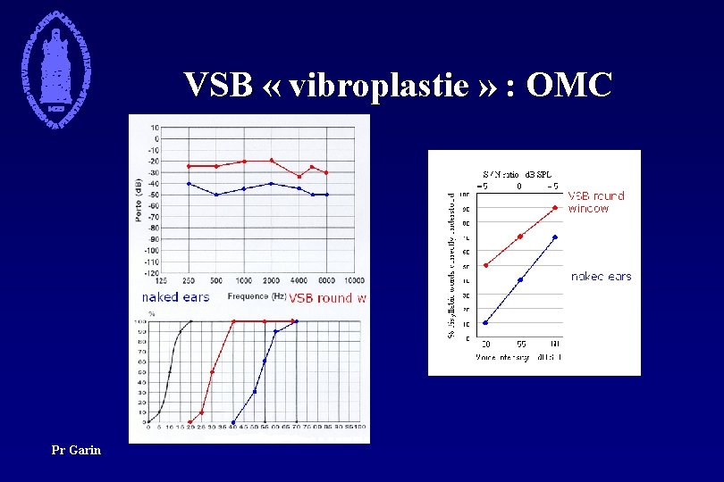 VSB « vibroplastie » : OMC Pr Garin 