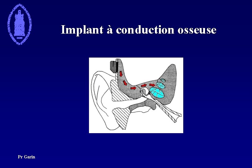 Implant à conduction osseuse Pr Garin 