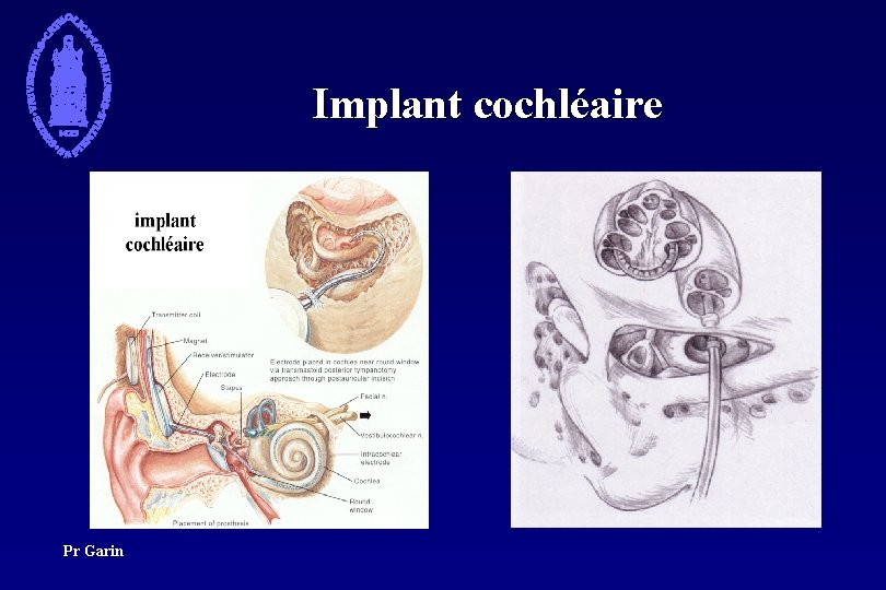 Implant cochléaire Pr Garin 