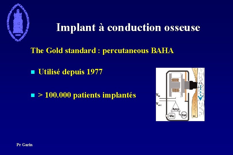 Implant à conduction osseuse The Gold standard : percutaneous BAHA n Utilisé depuis 1977